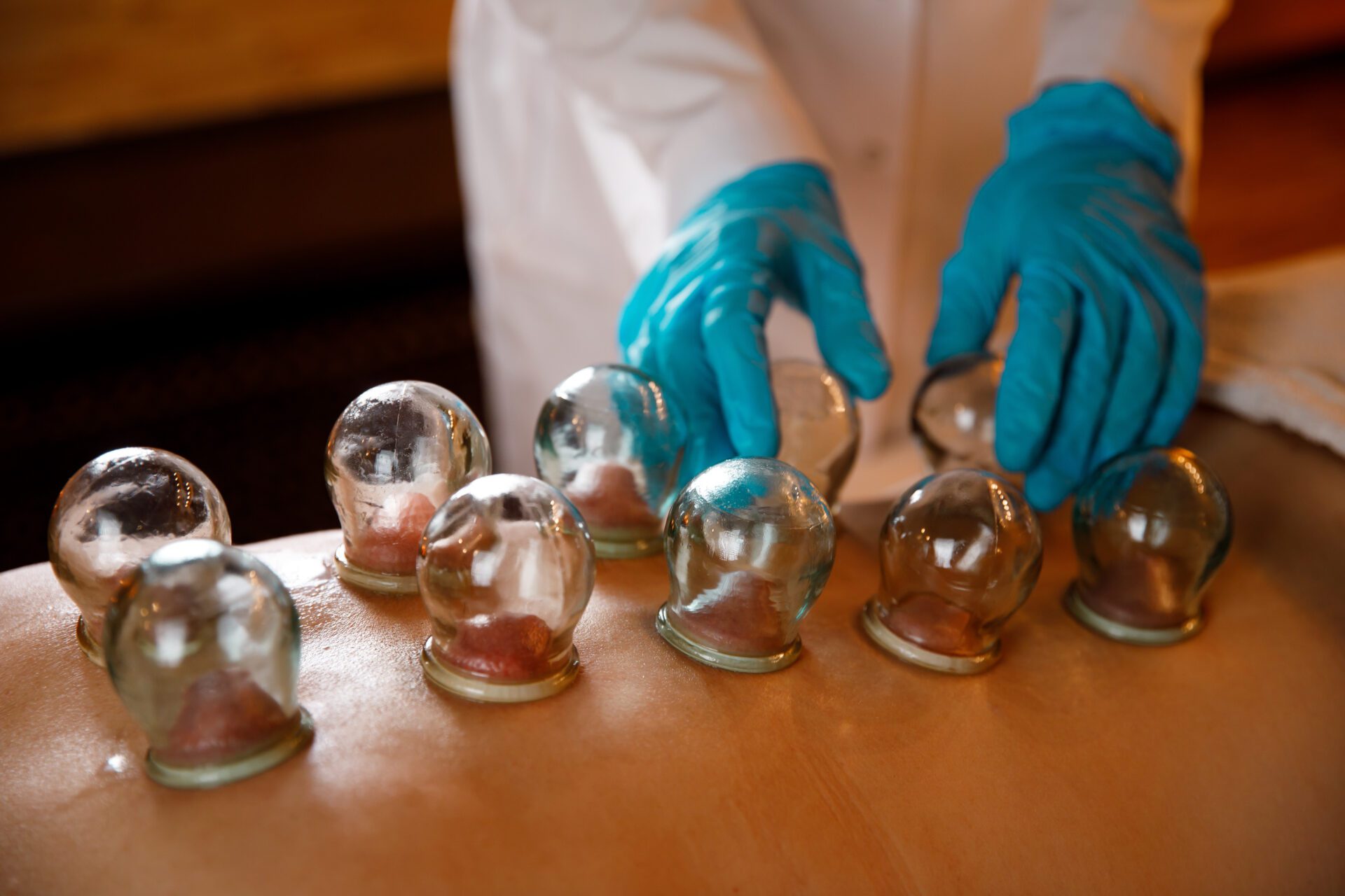 A young woman relaxes in a massage parlor. Vacuum cups of medical cupping therapy on woman back, close up, chinese medicine. A young woman relaxes in a massage parlor. Vacuum cups of medical cupping therapy on woman back, close up, chinese medicine.